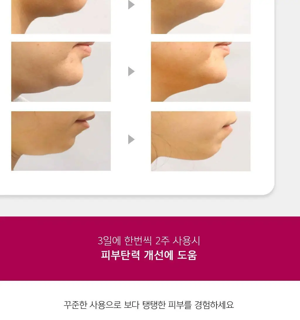 [브이라인/리프팅 패치] 아나시스 벨라컨투어 듀얼리프트마스크 5매 상세페이지 10